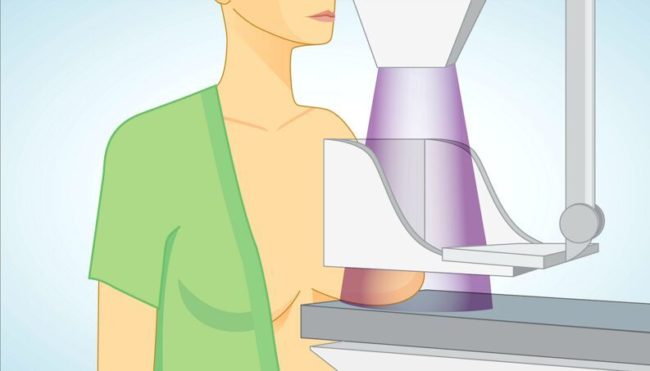 mamografia-novo-exame-1116-1400×8002